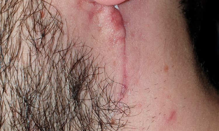 Centro termale e cicatrice da adenoma pleomorfo - 52507