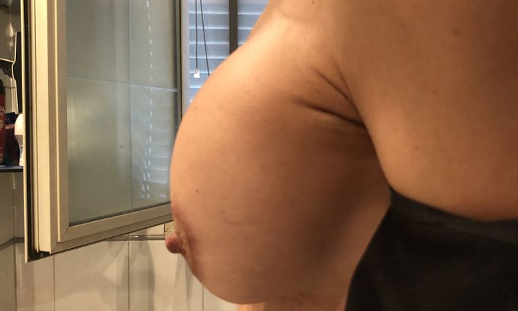 Strana forma dopo due mesi dalla mastopessi - 53106