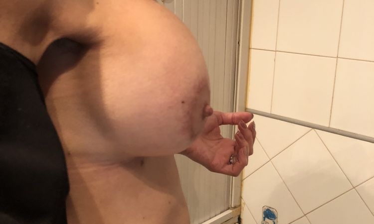 Strana forma dopo due mesi dalla mastopessi - 53108