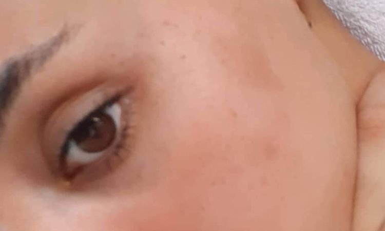 Iperpigmentazione post infiammatoria o melasma? - 53124