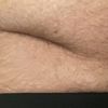 Pelle attacca alla parete addominale dopo intervento appendicite, cosa fare?