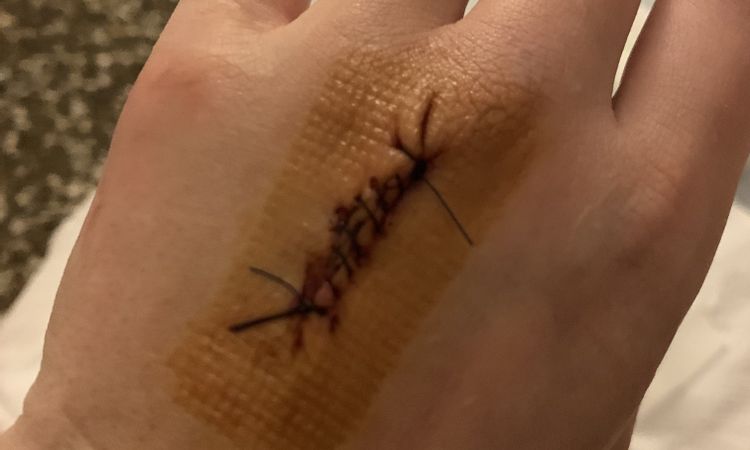 È possibile che per togliere un nevo ho un taglio di 3cm? - 53279