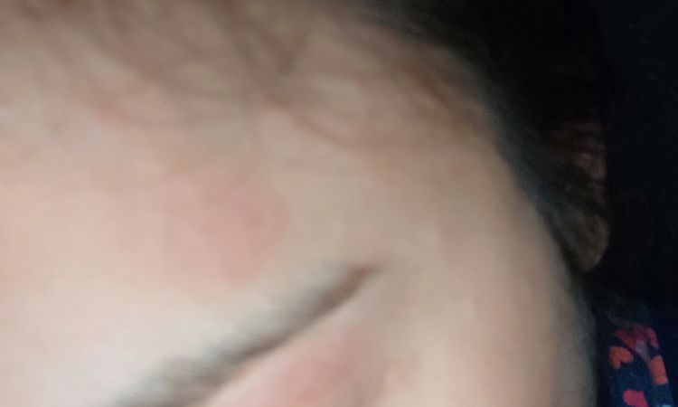 Macchia da crema al cortisone - 53504