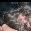 Ispessimento zona del cuoio capelluto post dermatite seborroica