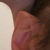 Trattamento otoplastica con earfold può risolvere il mio caso?