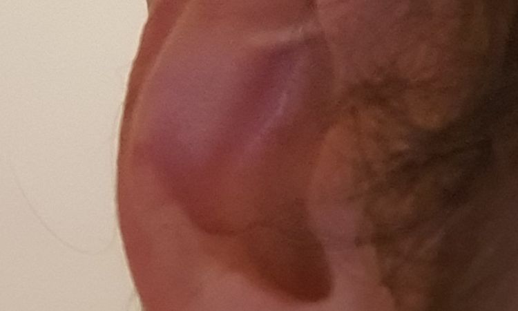 Trattamento otoplastica con earfold può risolvere il mio caso? - 53679