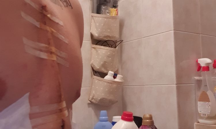 Pelle gonfia attorno alla cicatrice - 53805
