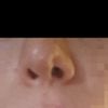 Naso asimmetrico post Rinoplastica e foro sulla narice (foto)