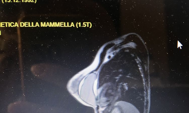 Sieroma intracpasulare - 53982