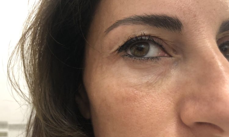 Sopracciglio calato anche dopo 2 mesi dal botox - 54192