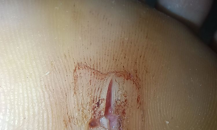 Infezione pianta piede - 54230