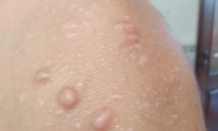 cicatrici ipertrofiche da acne - 54236