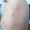 cicatrici ipertrofiche da acne