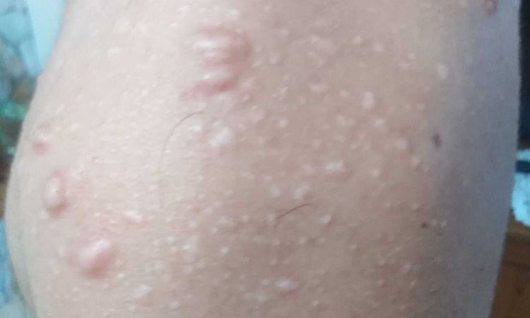 cicatrici ipertrofiche da acne - 54237