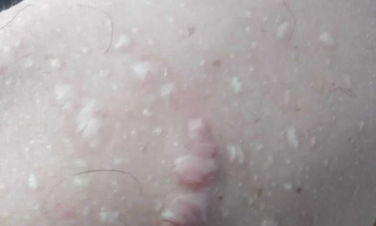 cicatrici ipertrofiche da acne - 54238