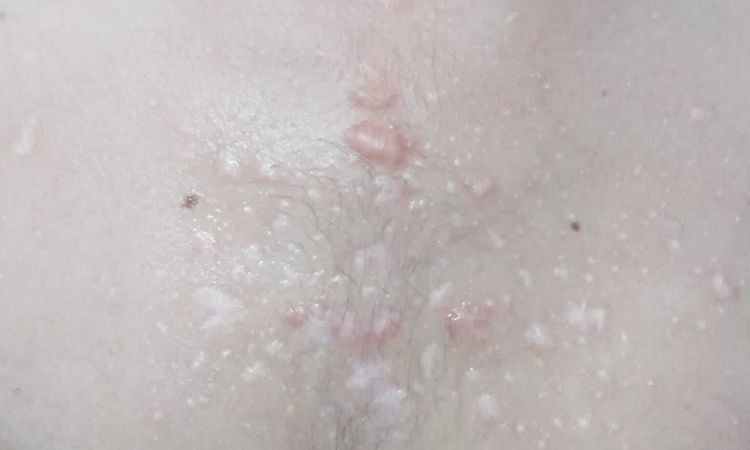 cicatrici ipertrofiche da acne - 54239