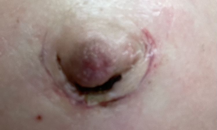 Mastoplastica cicatrice periareolare con punti post 1 mese - 54543