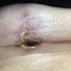 Pus cicatrice Mastopessi