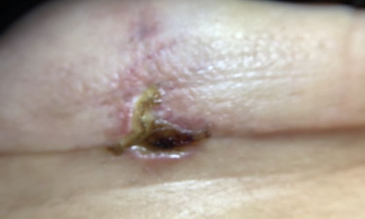 Pus cicatrice Mastopessi - 54675