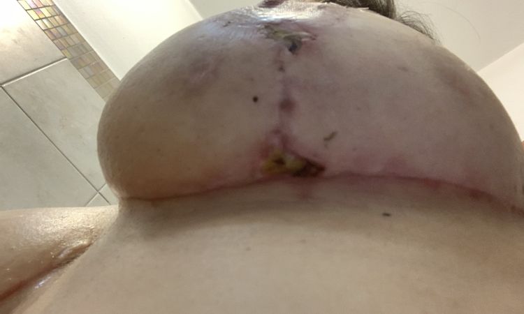 Pus cicatrice Mastopessi - 54676
