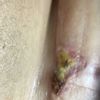 Pus cicatrice Mastopessi