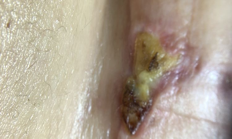 Pus cicatrice Mastopessi - 54677