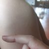 Bolle rosse su dita mani