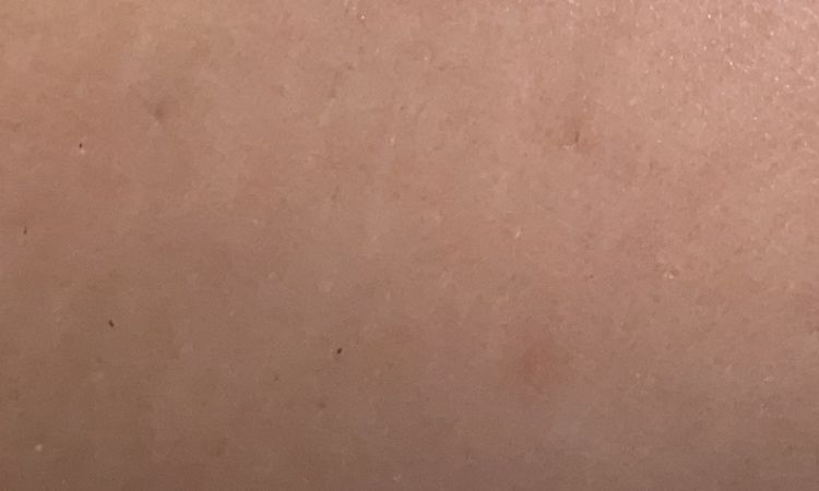 Nel bruciato da epilazione laser - 54781