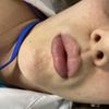 Filler labbra dopo 20 giorni
