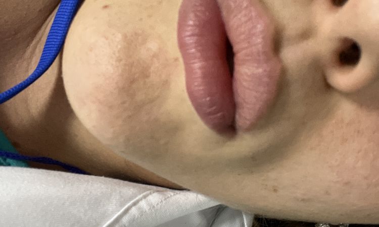 Filler labbra dopo 20 giorni - 55393