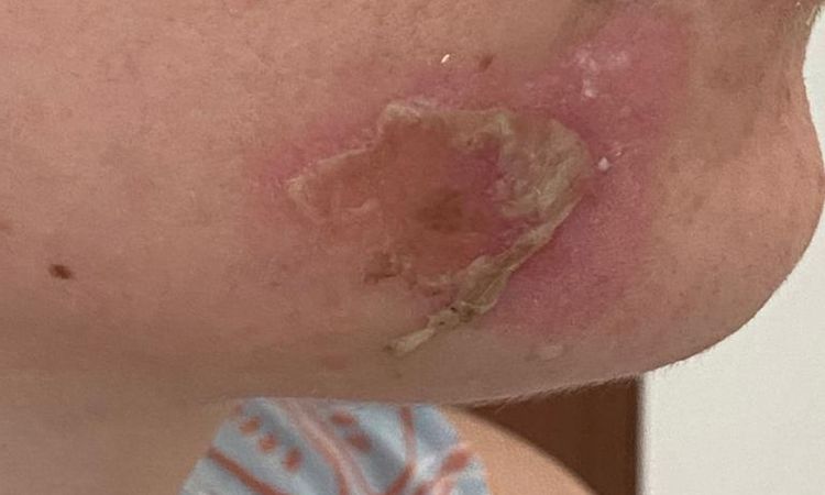 Abrasione asfalto post incidente - 55417