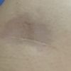 Infiltrazioni di cortisone su cicatrici