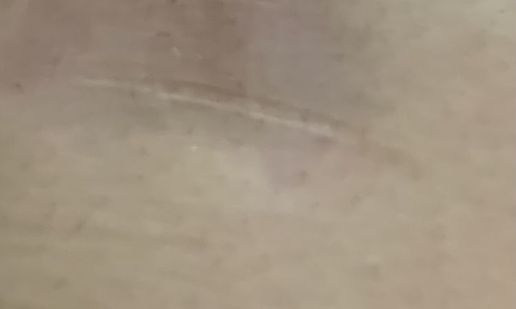 Infiltrazioni di cortisone su cicatrici - 55484