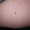 Neo o melanoma sulla gamba