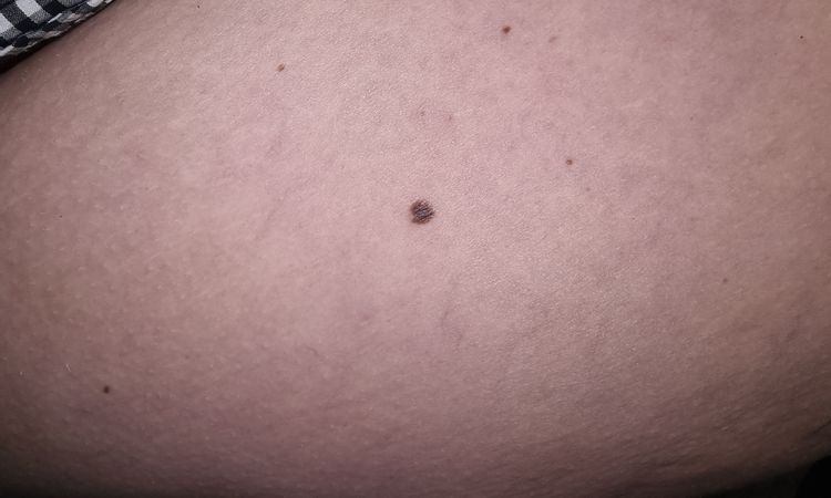 Neo o melanoma sulla gamba - 56018