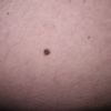 Neo o melanoma sulla gamba