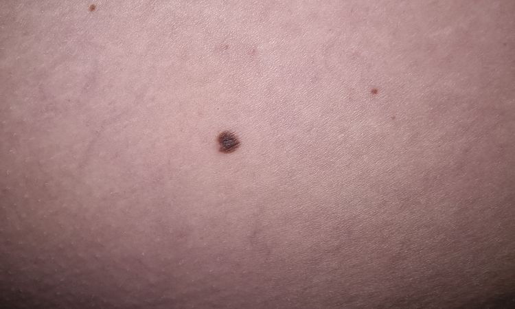 Neo o melanoma sulla gamba - 56019