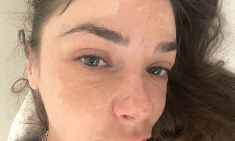 Melasma? Malattia autoimmune? Altro? - 56341