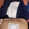 Sangue dal foro di drenaggio