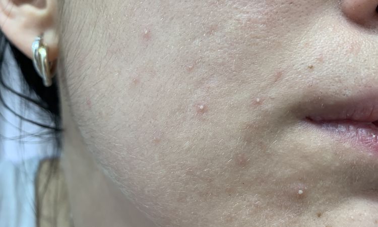 Acne due anni dopo isotretinoina - 56710