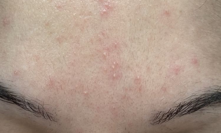 Acne due anni dopo isotretinoina - 56711