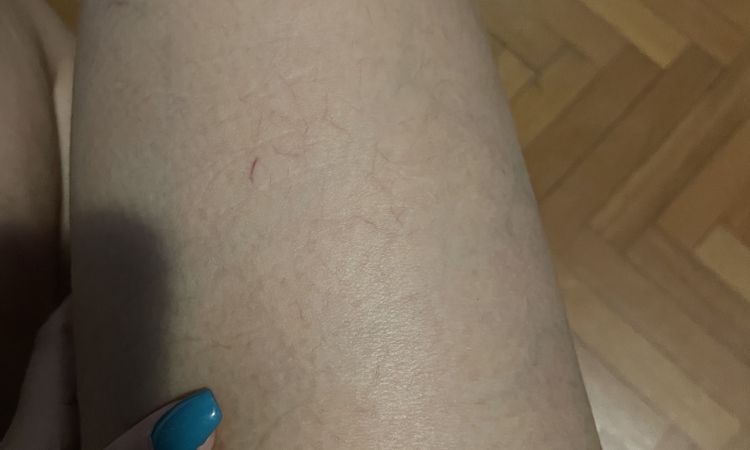 Ho 26 anni e ho tanti capillari evidenti - 56913