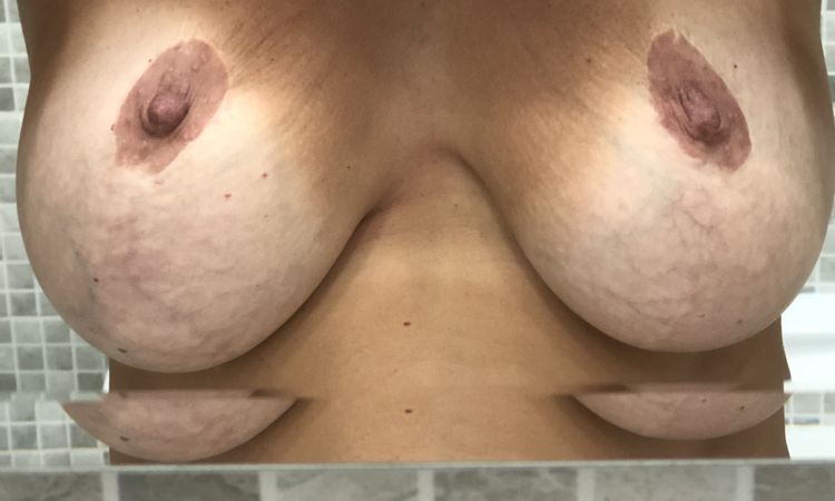 Tre interventi di mastoplastica sbagliati - 57022