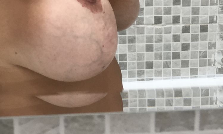 Tre interventi di mastoplastica sbagliati - 57023