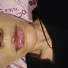 Filler labbra  parti bianche e lividi