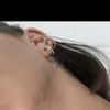 Acne estiva o acne estivalis