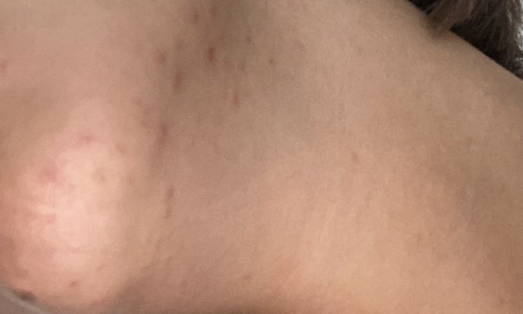 Acne estiva o acne estivalis - 57690