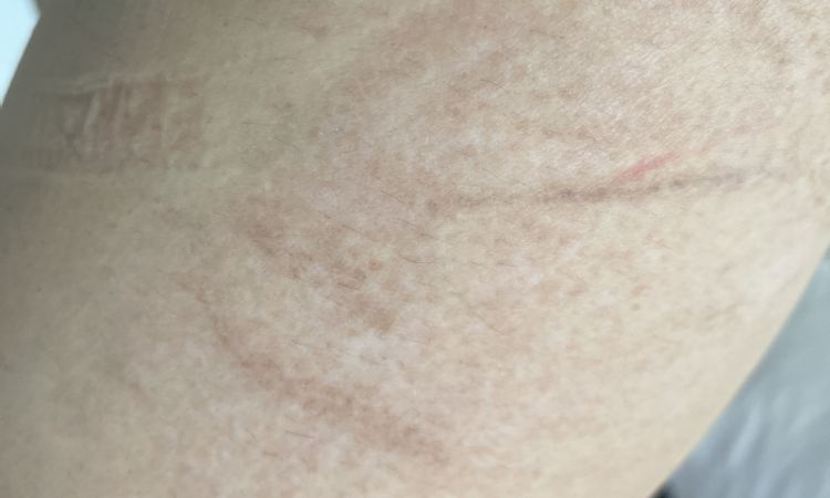 Abrasioni gambe asfalto - 58512