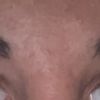 Columella naso post rinoplastica “polly beak”