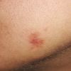 Infiammazione post rimozione chirurgica cisti sebacea